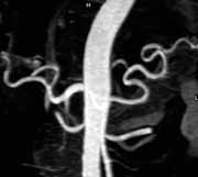 MR - Angiographie